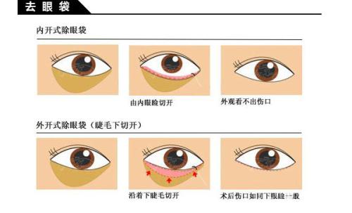 祛眼袋手术方法