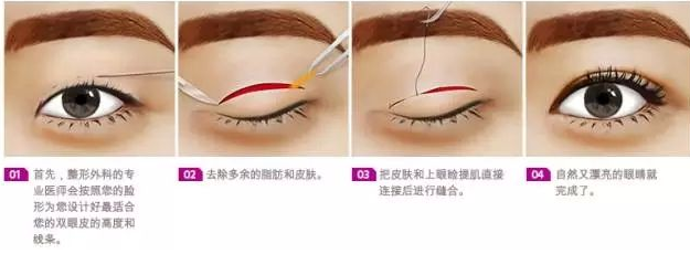 切开法双眼皮过程图示