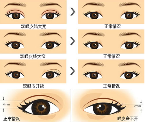 失败双眼皮的几种类型