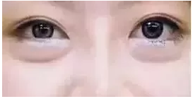 遗传型眼袋