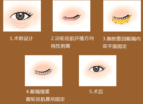眶隔脂肪释放去眼袋过程示意图