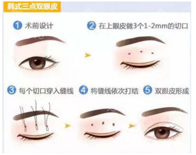 韩式三点双眼皮手术过程