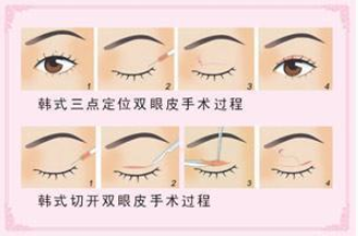 韩式双眼皮的过程示意图