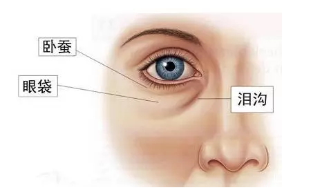眼袋、泪沟、卧蚕的区别