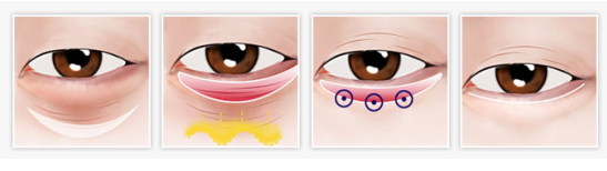 微创无痕祛眼袋治疗过程示意图