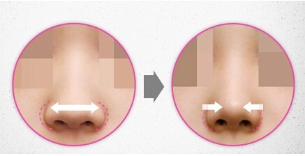 鼻部修复效果图