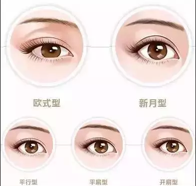 双眼皮的五种形态