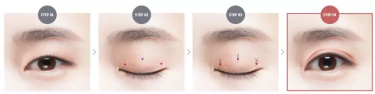 韩式三点双眼皮手术过程示意图