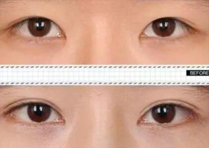 韩国纳米无痕双眼皮案例