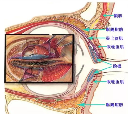 双眼皮手术解剖示意图