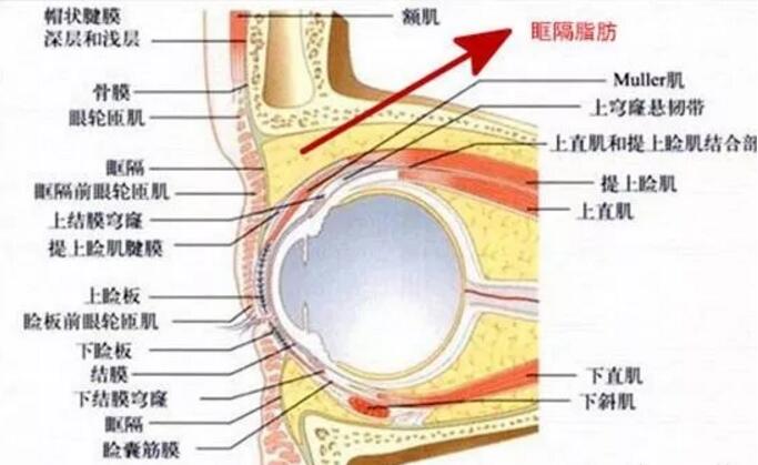 看红色箭头所指的，肿泡眼的眶隔脂肪比一般的眼睛要多