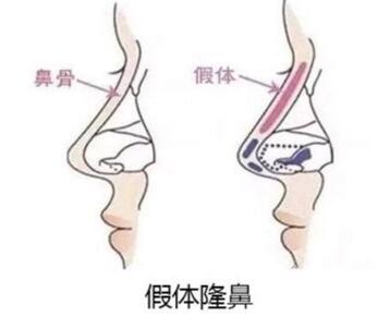 隆鼻假体/自体软骨放置的位置