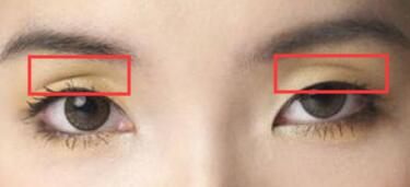 常见的眼部衰老迹象之一眼窝凹陷