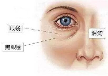 眼袋和泪沟的区别