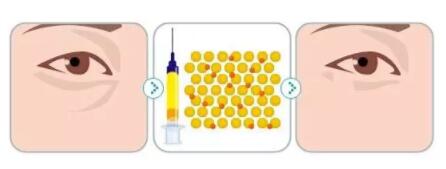 自体脂肪填充泪沟