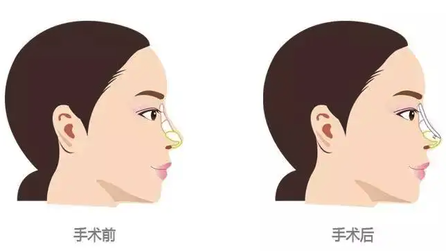 隆鼻和鼻综合有何区别