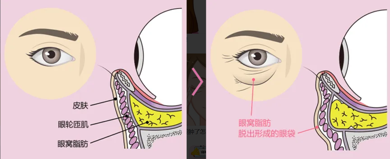 手术祛眼袋和激光祛眼袋选哪个比较好