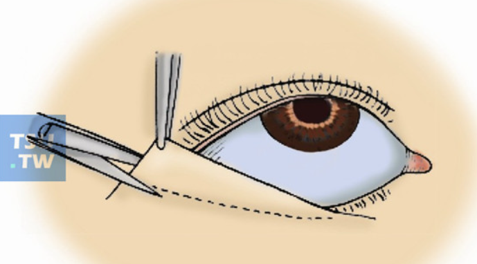 外眼角疤痕粘连皮瓣转移修复法