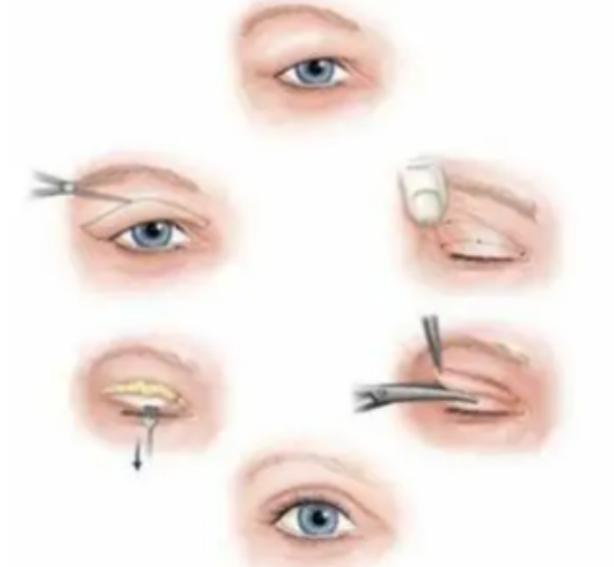 韩国双眼皮修复手术