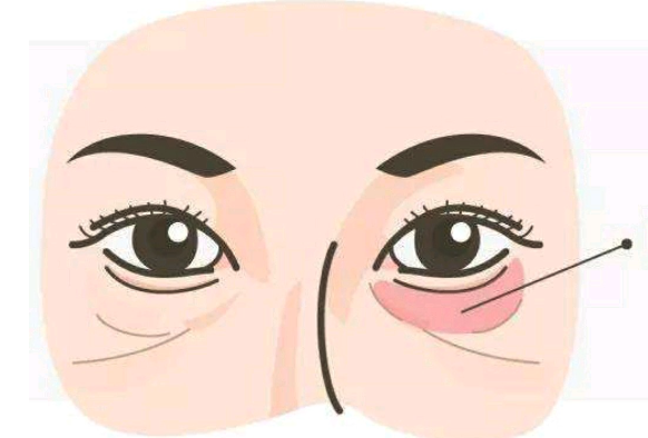 手术祛眼袋之后注意哪些事项