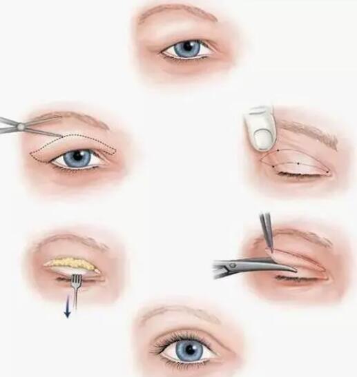 双眼皮提肌手术是什么