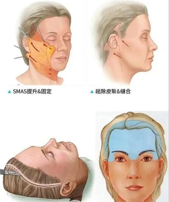 面部筋膜提升过程图示