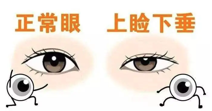 上睑下垂手术和双眼皮手术的区别，回答上睑下垂可以做双眼皮吗？