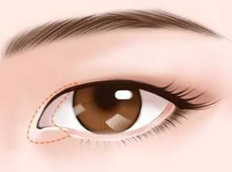 开内眼角术后眼角有分泌物正常吗