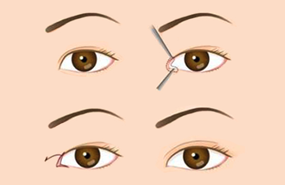 开眼角的疤多久能恢复？如果开眼角留下的白色疤痕怎么去除？