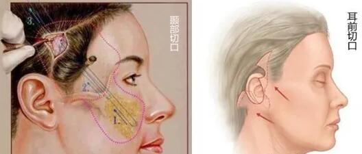 60岁适合做小切口面部提升术吗？看清潭first成镇模怎么说？