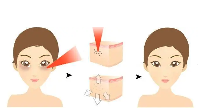 激光去眼袋全过程展示，理性看激光去眼袋能保持多久？