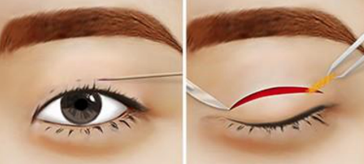 多层眼皮怎么恢复成双眼皮？(眼皮多层褶皱可以做双眼皮手术来改善)