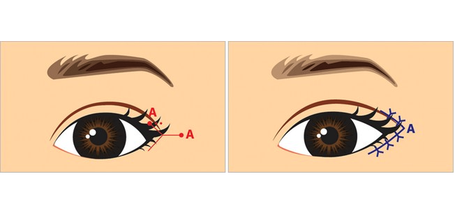 开眼角手术是怎么做的？来看开眼角手术步骤详解