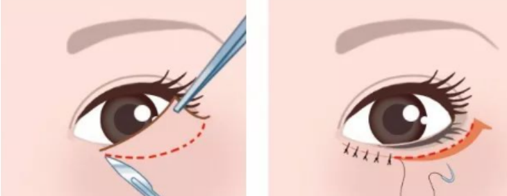 眼袋手术动画图