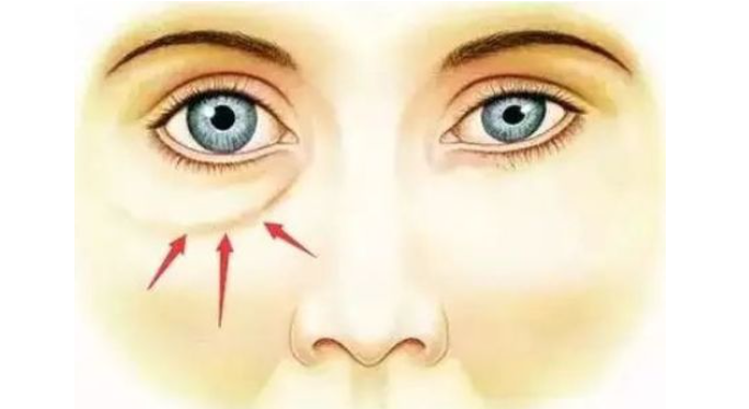 外切眼袋术后眼睛干涩多久恢复？