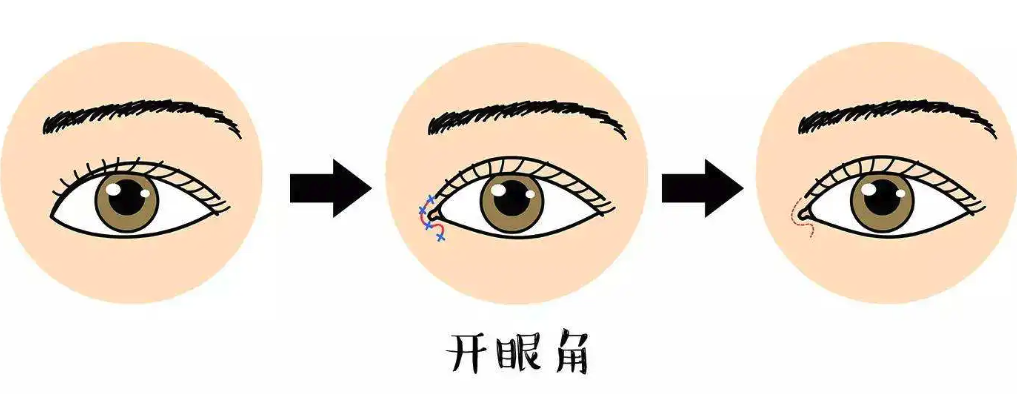 开眼角失败可以修复吗？可以详看开眼角失败修复复杂不？