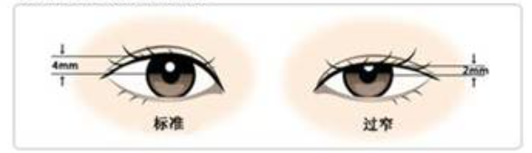 埋线双眼皮越来越窄的原因在此,并解答双眼皮窄变宽补救方法