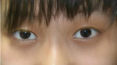 "金鱼眼"的人眼球外凸,做了双眼皮反而会使人觉得