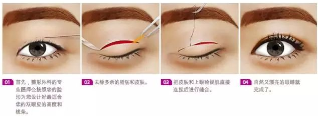 清潭第一成镇模院长带你了解双眼皮不同手术方法