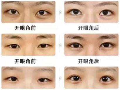 清潭第开眼角前后对比