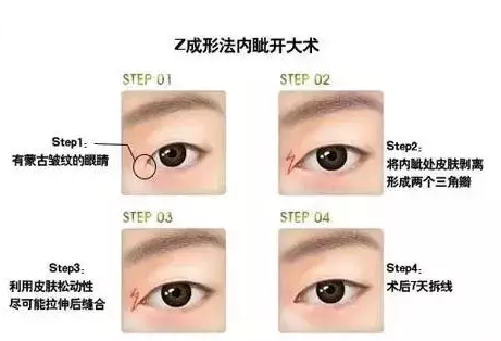 清潭firstZ成形法内眦开大术