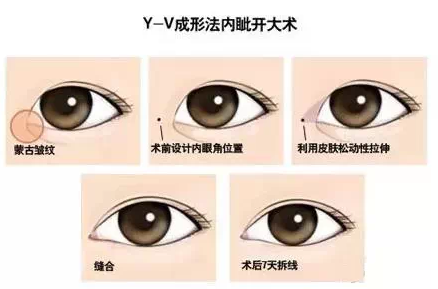 清潭firstY-V成形法内眦开大术
