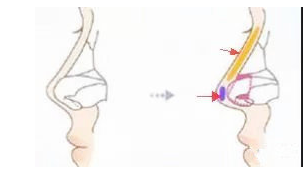 假体垫鼻梁+自体软骨垫鼻尖