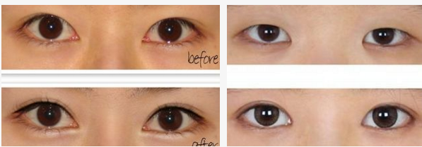 开眼角前后效果对比
