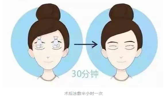 双眼皮术后浮肿怎么办？韩国清潭first讲双眼皮术后消肿方法