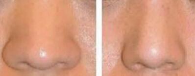 鼻头缩小术前术后对比