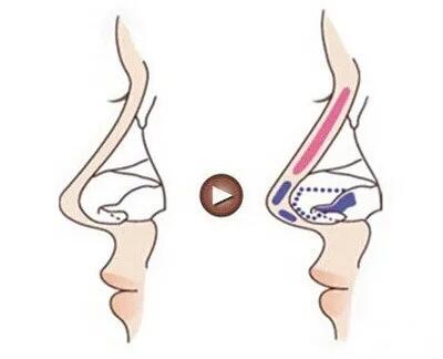 自体软骨隆鼻尖效果示例图