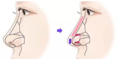 鼻综合整形前后对比效果照