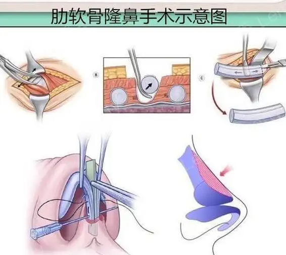 肋软骨隆鼻手术图示