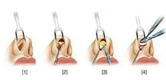 鼻头缩小手术过程